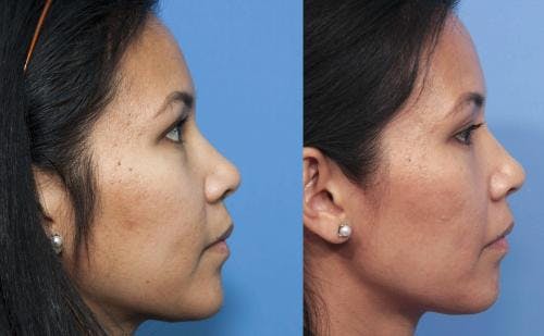 Laser Treatments Before & After Gallery - Patient 58214259 - Image 3