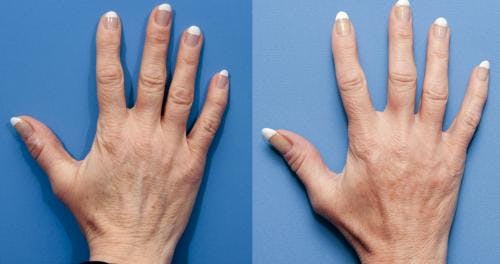 Hand Rejuvenation Before & After Gallery - Patient 58214260 - Image 1