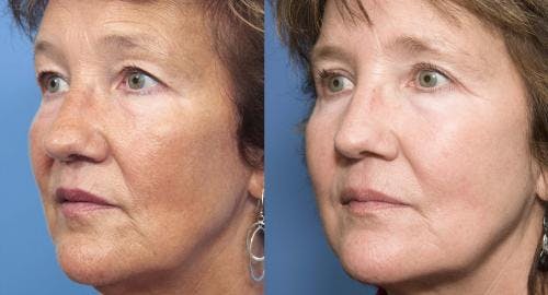 Laser Treatments Before & After Gallery - Patient 58214262 - Image 1