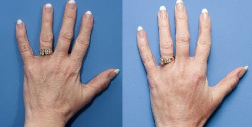 Hand Rejuvenation Before & After Gallery - Patient 58214260 - Image 2