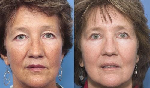 Laser Treatments Before & After Gallery - Patient 58214262 - Image 2