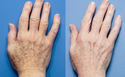 Hand Rejuvenation Before & After Gallery - Patient 58214263 - Image 1