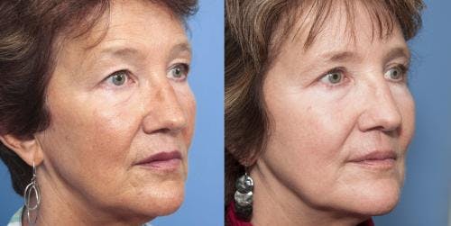 Laser Treatments Before & After Gallery - Patient 58214262 - Image 3