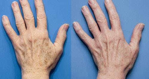 Hand Rejuvenation Before & After Gallery - Patient 58214263 - Image 2