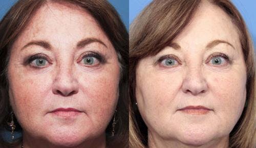 Laser Treatments Before & After Gallery - Patient 58214265 - Image 1