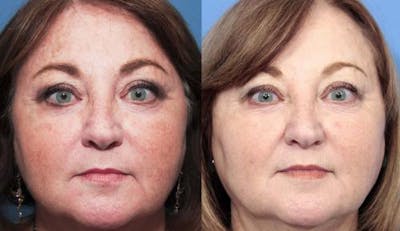 Laser Treatments Before & After Gallery - Patient 58214265 - Image 1
