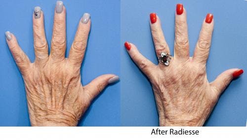 Hand Rejuvenation Before & After Gallery - Patient 58214264 - Image 1