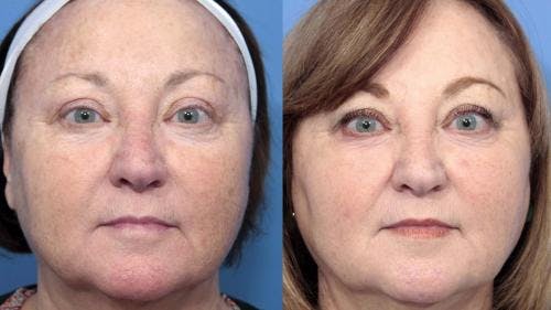 Laser Treatments Before & After Gallery - Patient 58214265 - Image 2