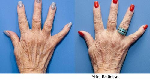 Hand Rejuvenation Before & After Gallery - Patient 58214264 - Image 2