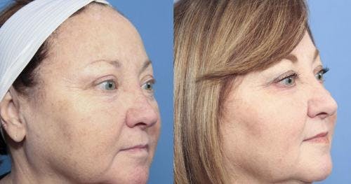 Laser Treatments Before & After Gallery - Patient 58214265 - Image 3