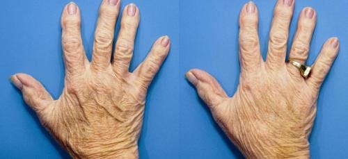 Hand Rejuvenation Before & After Gallery - Patient 58214266 - Image 1