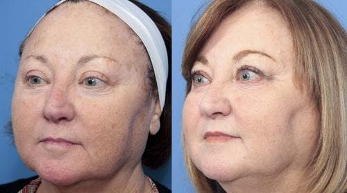 Laser Treatments Before & After Gallery - Patient 58214265 - Image 4