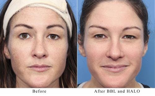 Laser Treatments Before & After Gallery - Patient 58214269 - Image 1