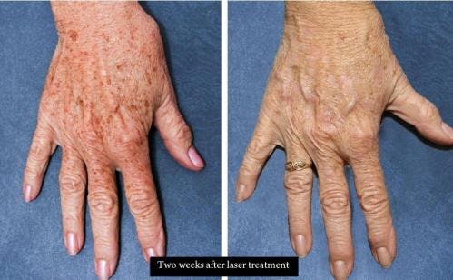 Hand Rejuvenation Before & After Gallery - Patient 58214267 - Image 1
