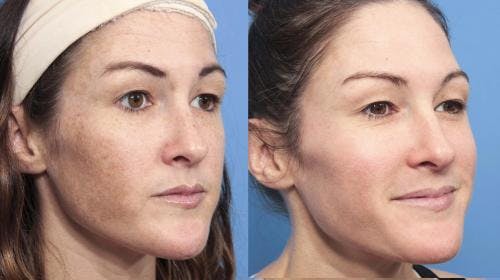 Laser Treatments Before & After Gallery - Patient 58214269 - Image 2
