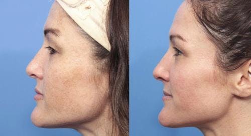 Laser Treatments Before & After Gallery - Patient 58214269 - Image 3