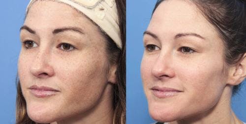 Laser Treatments Before & After Gallery - Patient 58214269 - Image 4
