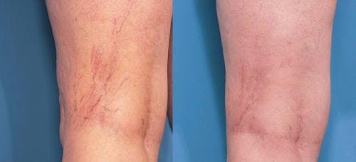 Vein Treatment Before & After Gallery - Patient 58214268 - Image 1