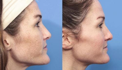 Laser Treatments Before & After Gallery - Patient 58214269 - Image 5