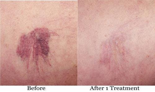 Vein Treatment Before & After Gallery - Patient 58214270 - Image 1