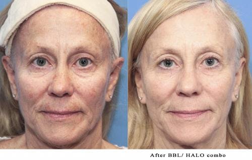 Laser Treatments Before & After Gallery - Patient 58214272 - Image 1