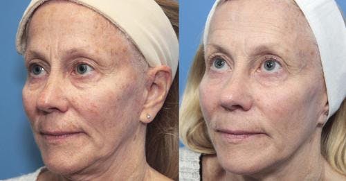 Laser Treatments Before & After Gallery - Patient 58214272 - Image 2