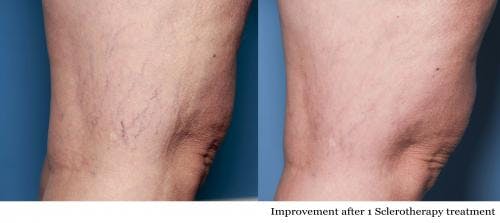 Vein Treatment Before & After Gallery - Patient 58214271 - Image 1