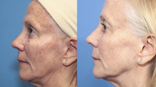 Laser Treatments Before & After Gallery - Patient 58214272 - Image 3