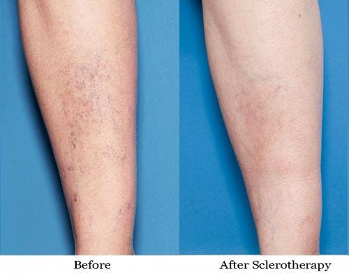 Vein Treatment Before & After Gallery - Patient 58214273 - Image 1
