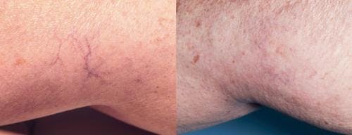 Vein Treatment Before & After Gallery - Patient 58214275 - Image 1