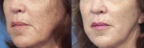Laser Treatments Before & After Gallery - Patient 58214278 - Image 1