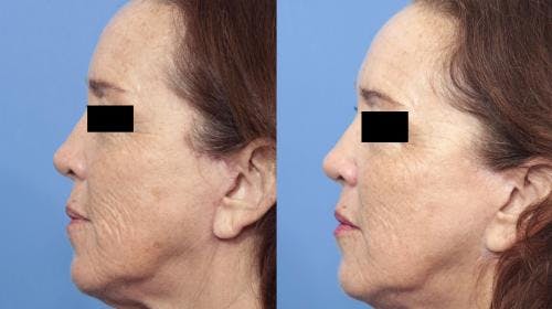 Laser Treatments Before & After Gallery - Patient 58214278 - Image 4