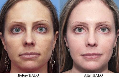 Laser Treatments Before & After Gallery - Patient 58214279 - Image 1