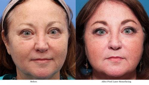 Laser Treatments Before & After Gallery - Patient 58214283 - Image 1