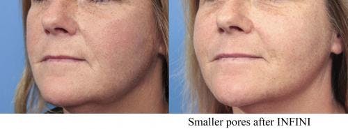 Infini Before & After Gallery - Patient 58214285 - Image 2