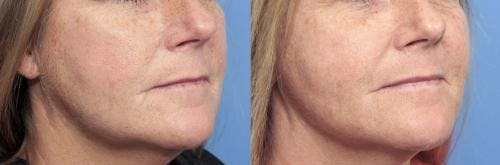 Infini Before & After Gallery - Patient 58214285 - Image 3