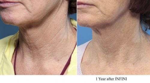 Infini Before & After Gallery - Patient 58214289 - Image 1