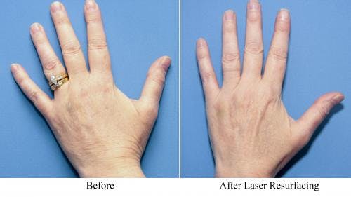 Laser Treatments Before & After Gallery - Patient 58214286 - Image 1