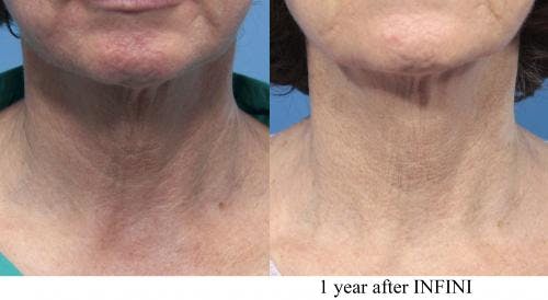 Infini Before & After Gallery - Patient 58214289 - Image 2