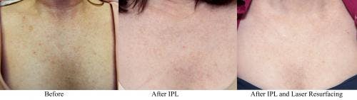 Laser Treatments Before & After Gallery - Patient 58214287 - Image 1
