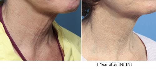Infini Before & After Gallery - Patient 58214289 - Image 3