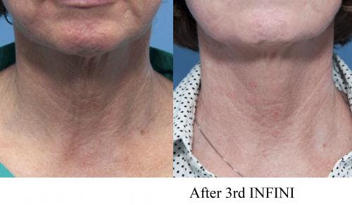 Infini Before & After Gallery - Patient 58214289 - Image 4