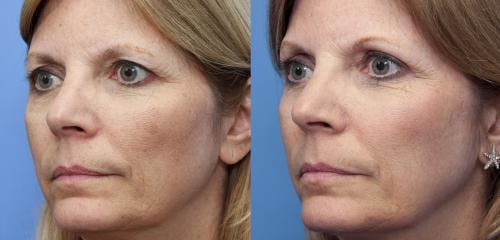 Laser Treatments Before & After Gallery - Patient 58214288 - Image 1