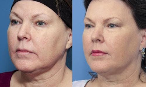 Infini Before & After Gallery - Patient 58214290 - Image 1