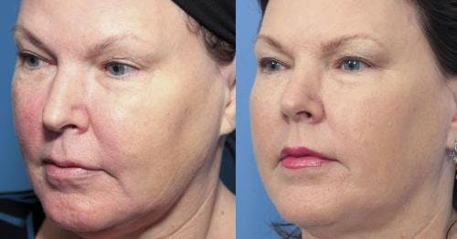 Infini Before & After Gallery - Patient 58214290 - Image 2