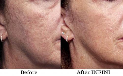 Infini Before & After Gallery - Patient 58214292 - Image 1