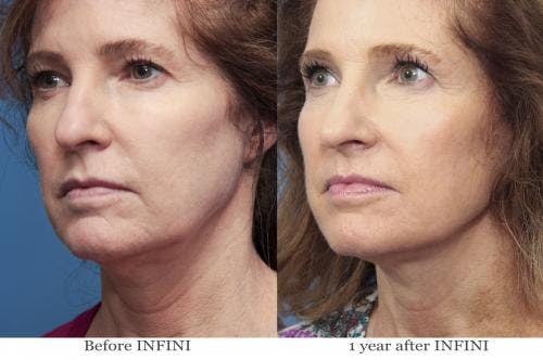 Infini Before & After Gallery - Patient 58214294 - Image 1