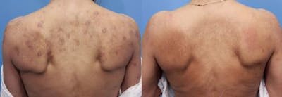 Laser Treatments Before & After Gallery - Patient 58214293 - Image 1