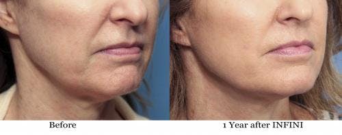 Infini Before & After Gallery - Patient 58214294 - Image 2