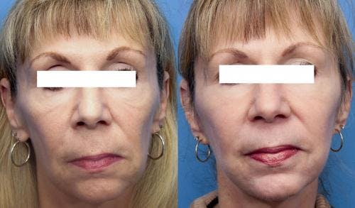 Laser Treatments Before & After Gallery - Patient 58214295 - Image 1